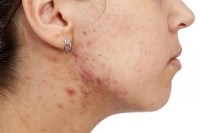 Facial_Hormonal_Acne
